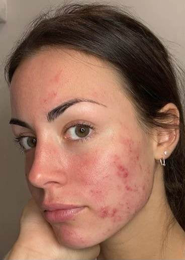 Woman with acne on her face against a plain background